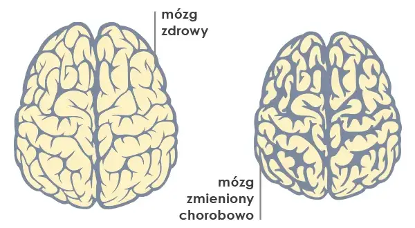 Demencja to nie choroba psychiczna? Poznaj kluczowe różnice