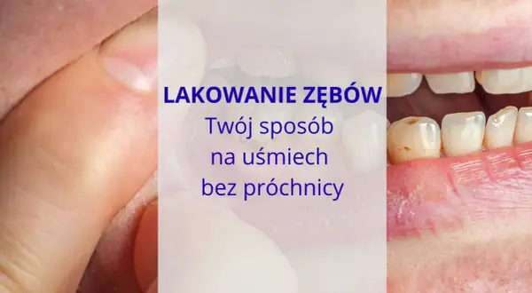 Jak skutecznie zapobiec próchnicy? Odkryj sekrety dentysty!