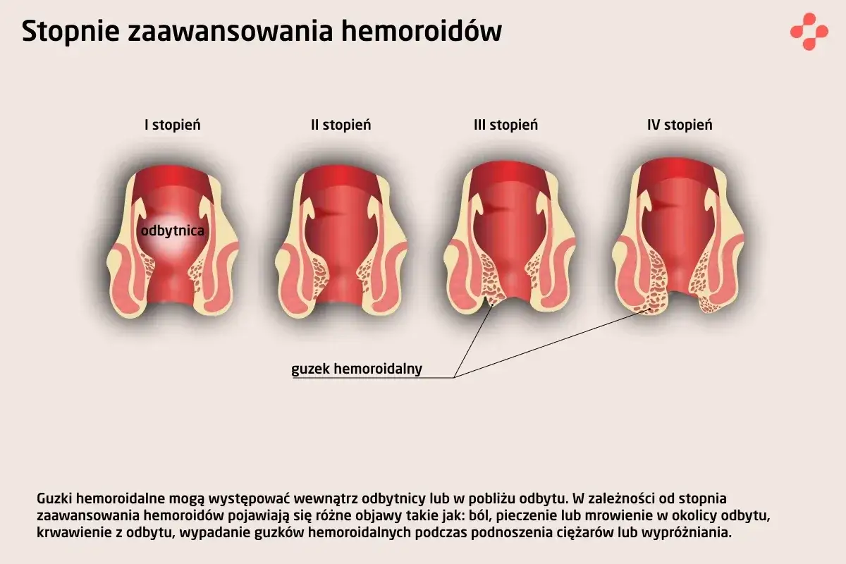 Ilustracja pokazuje cztery stopnie zaawansowania hemoroidów, od wewnętrznych do zewnętrznych, z widocznymi guzkami hemoroidalnymi.